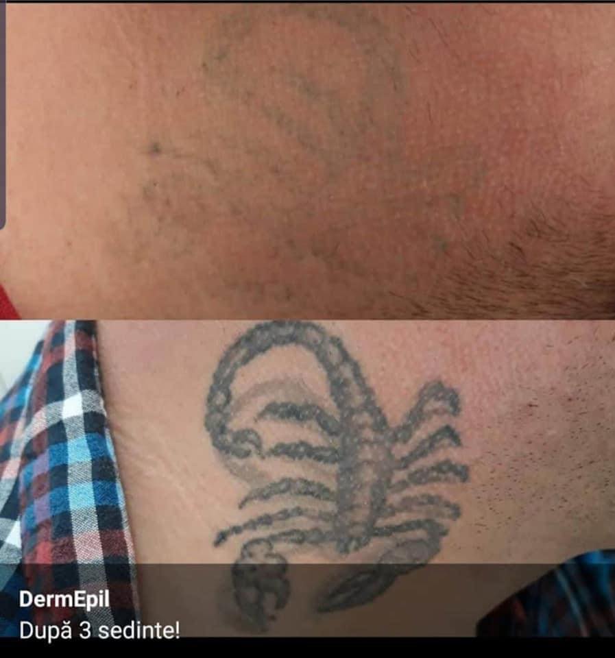 Indepartare Tatuaj Cu Laser Dermepil Herastrau Sector Bucuresti