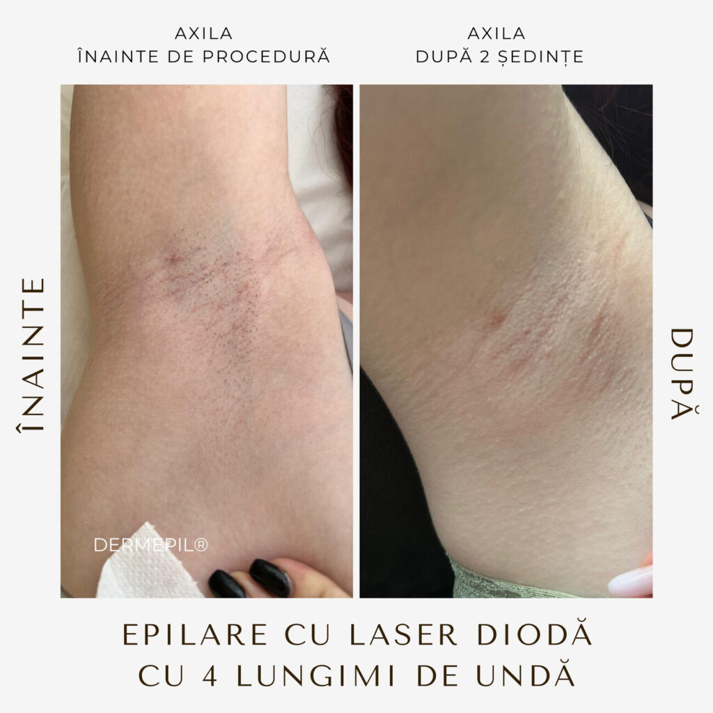 epilare-definitiva-before-and-after-2.png.jpg