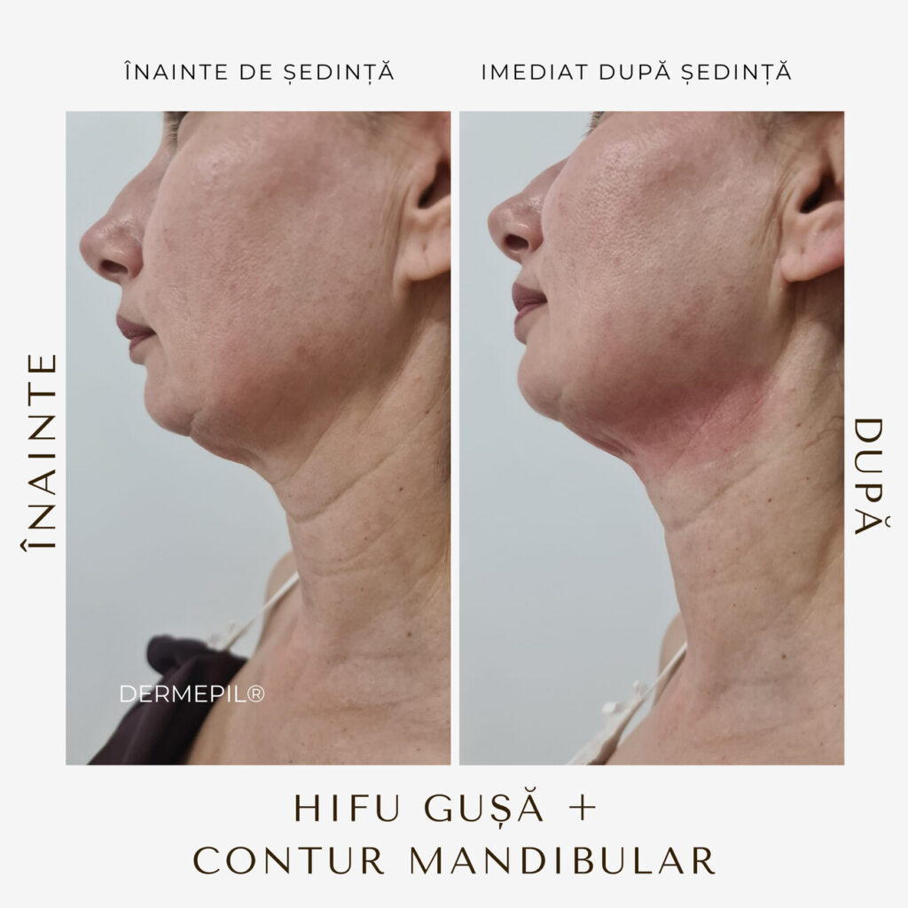 hifu-before-and-after-10.png.jpg