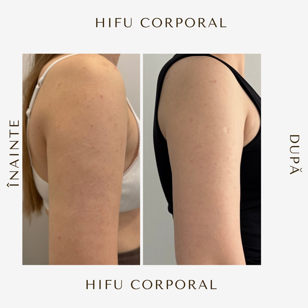 hifu-before-and-after-14.jpg