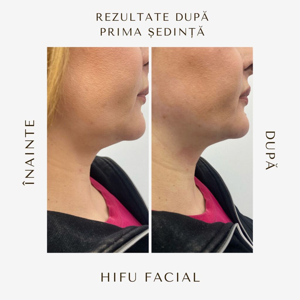 hifu-before-and-after-16.jpg