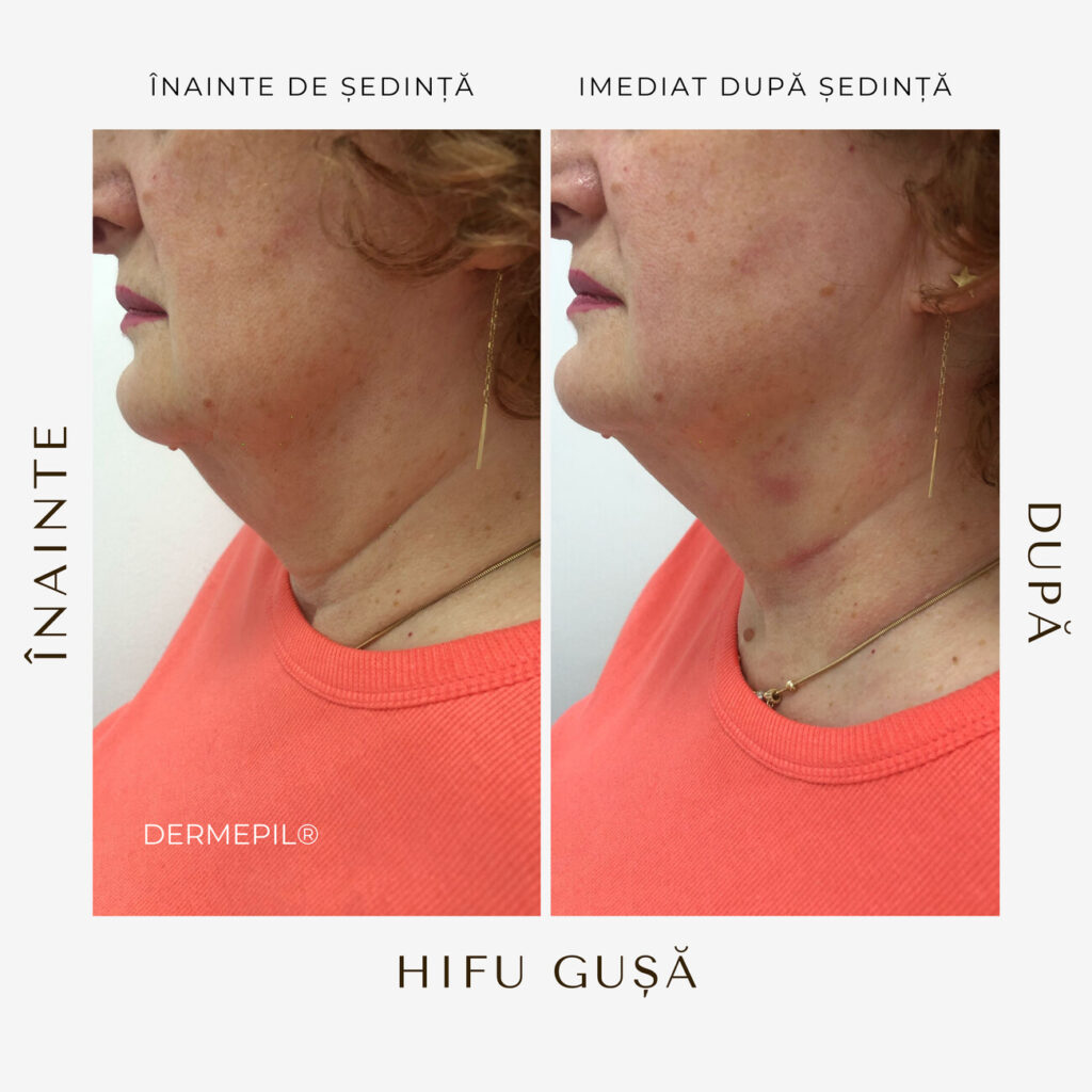 hifu-before-and-after-2.png.jpg