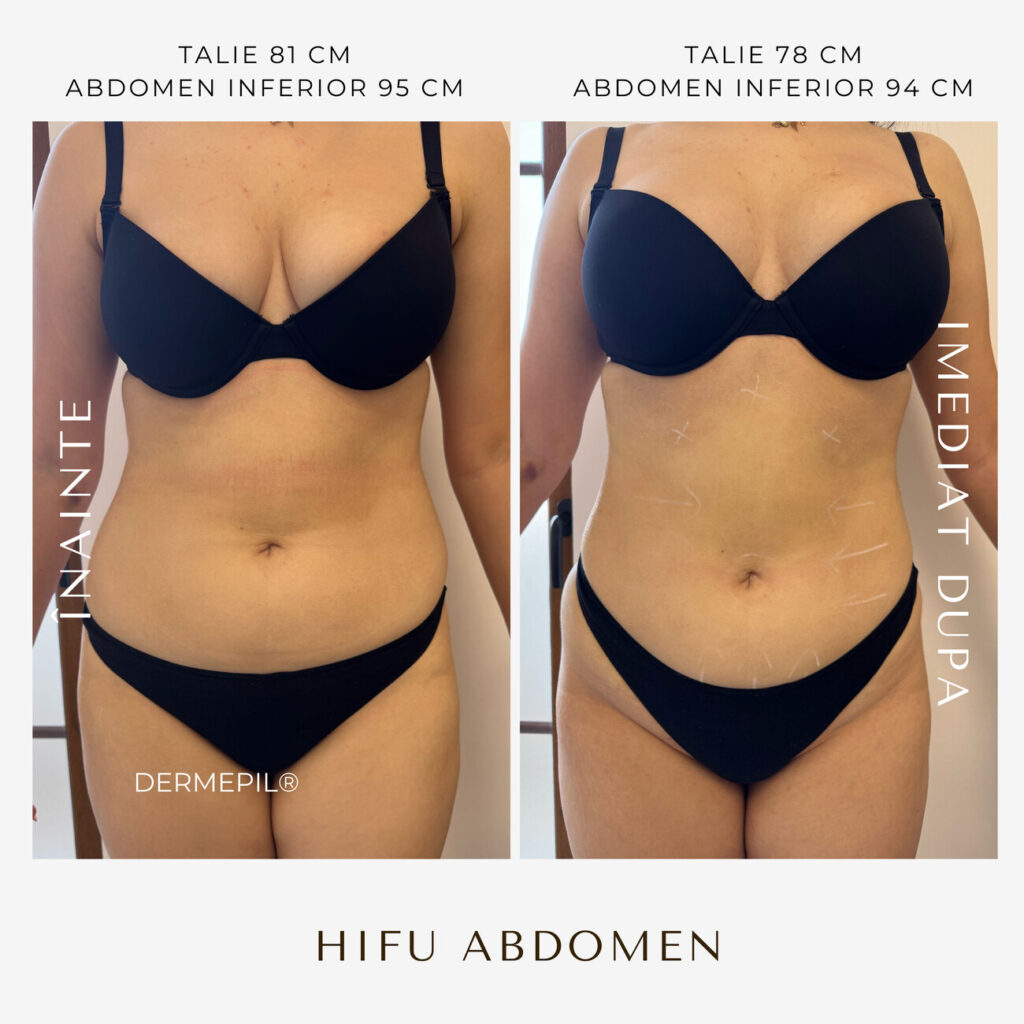 hifu-before-and-after-20.png.jpg
