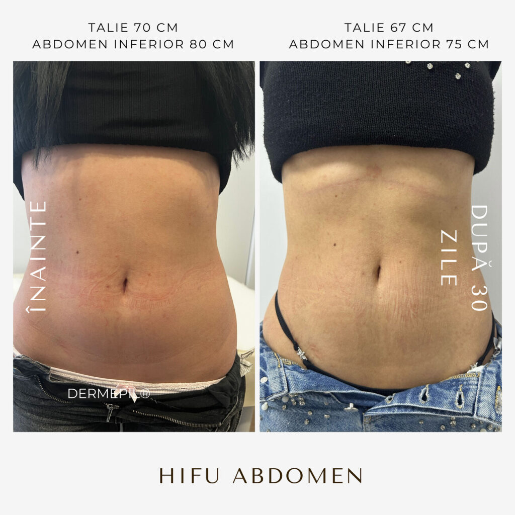 hifu-before-and-after-28.png.jpg