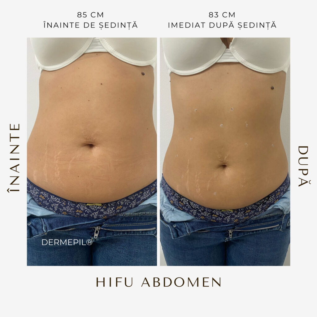 hifu-before-and-after-35.png.jpg