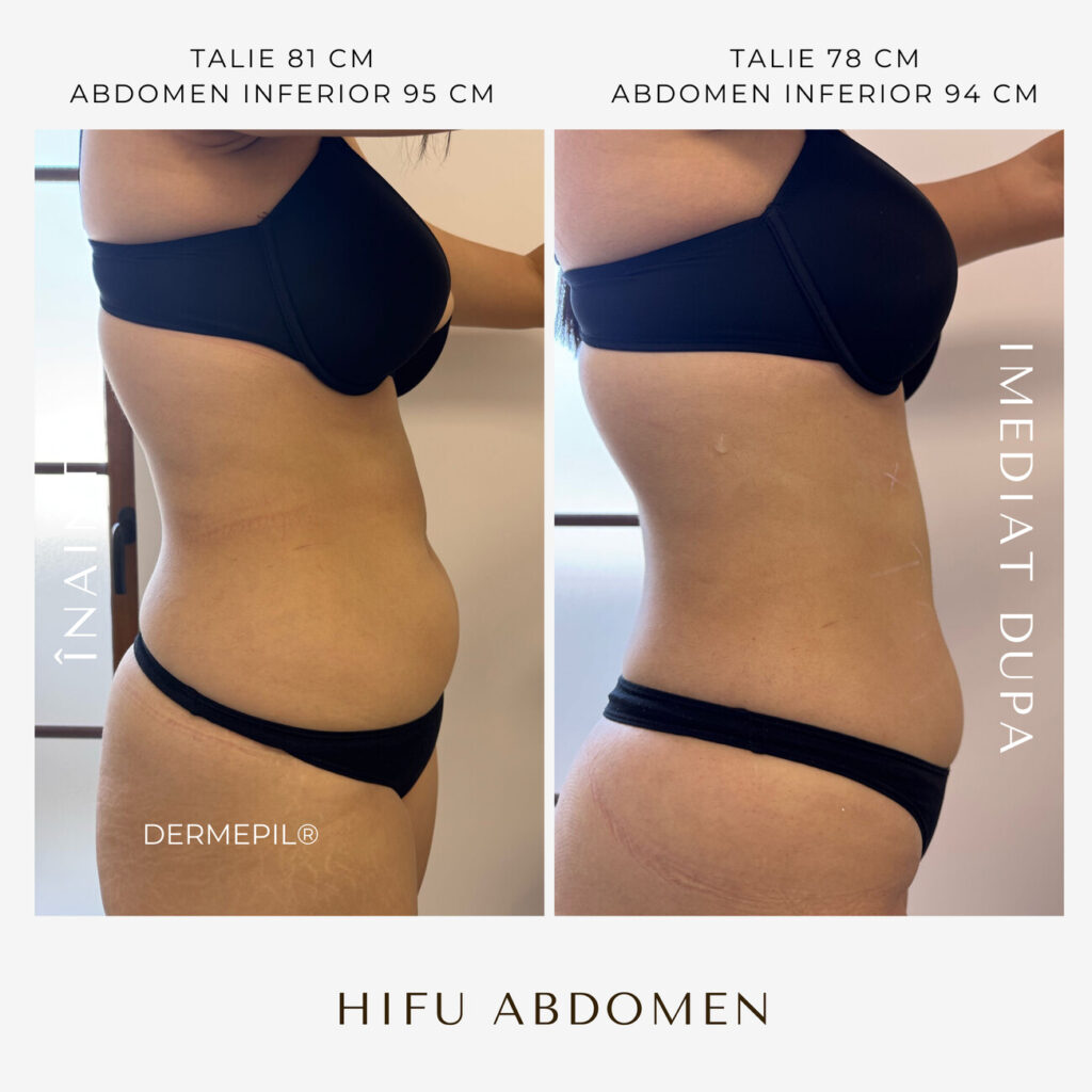 hifu-before-and-after-7.png.jpg