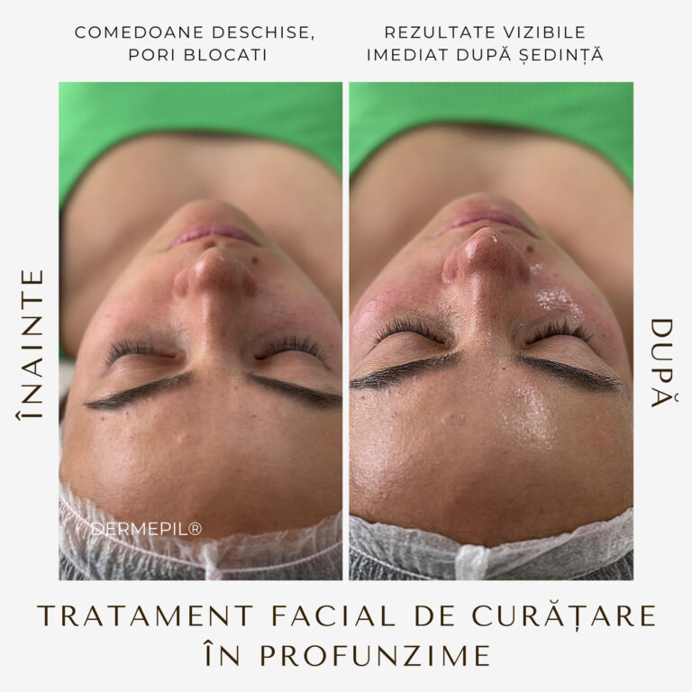 tratament-facial-curatare-8.jpg