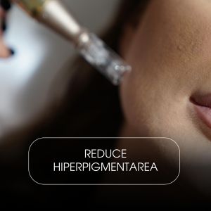 Microneedling cu Exozomi (Față & Gât)