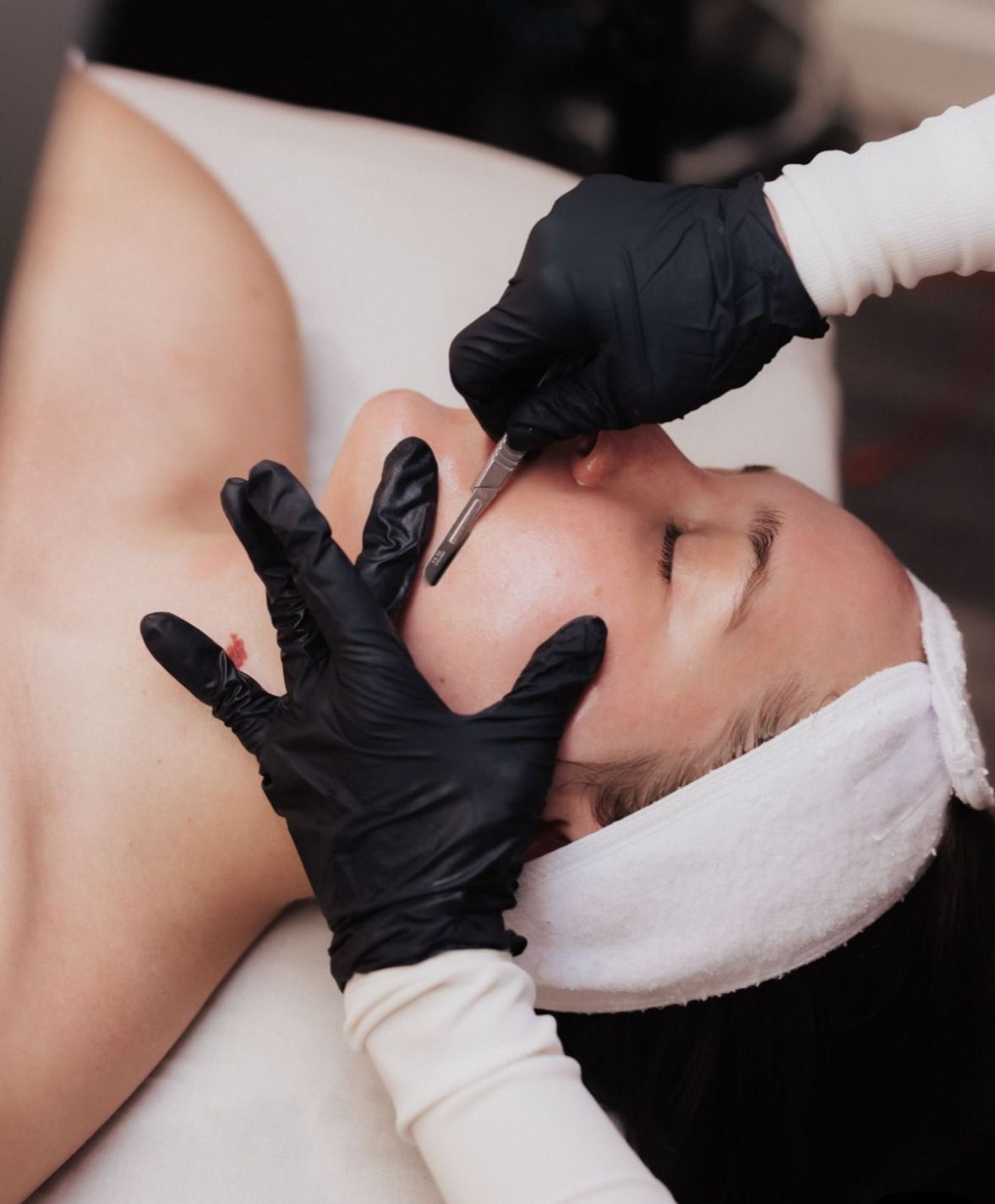 Dermaplaning cluj