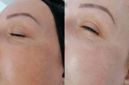Rejuvenare Faciala cu Laser Dioda