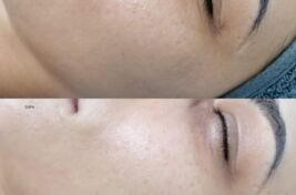 Rejuvenare Faciala cu Laser Dioda