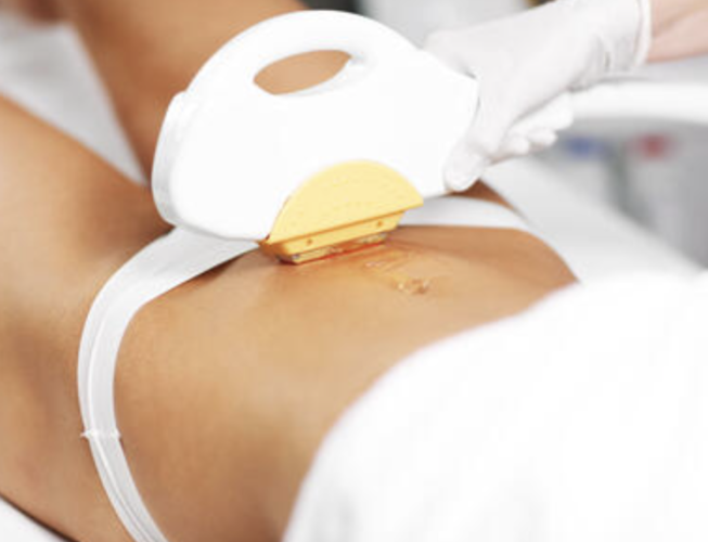 Pachet 3 Ședințe Epilare Definitivă – Linie Bikini / Linie Abdomen / Degete Mâini sau Picioare (3 Lungimi de Undă)