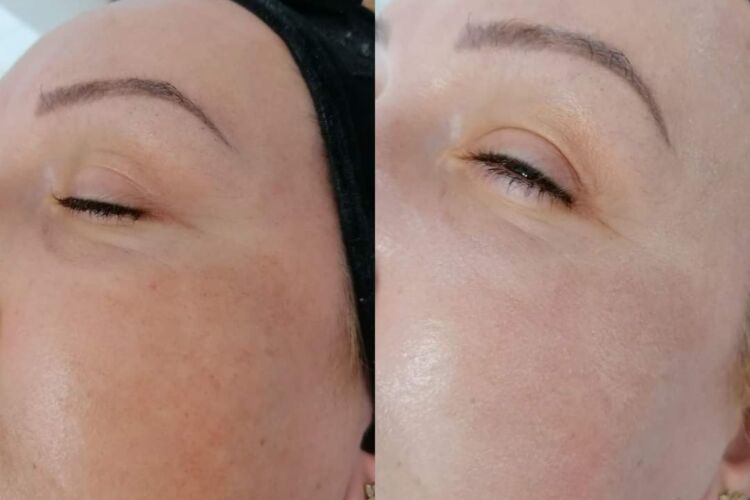 Pachet 6 Ședințe Rejuvenare Facială Cu Laser Diodă