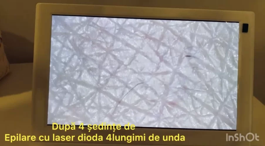 2 Consultații cu Camera Ultra- Zoom