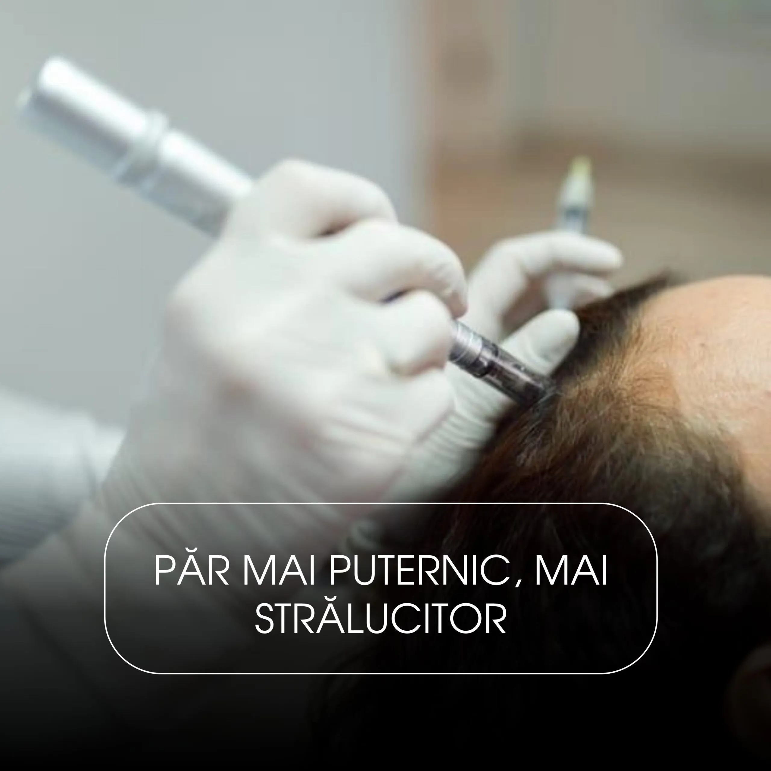 Microneedling Scalp cu Exozomi