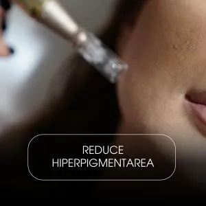 Microneedling cu Exozomi – Față & Gât