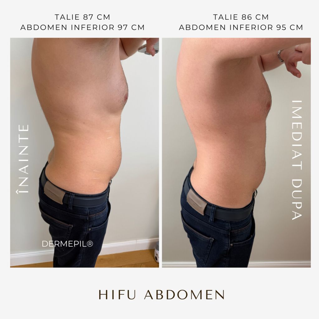 hifu-before-and-after-13.png.jpg