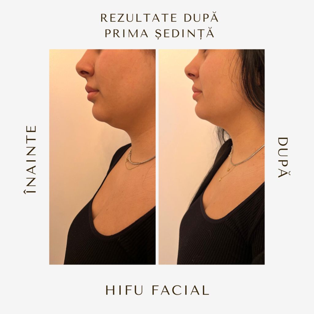 hifu-before-and-after-18.jpg