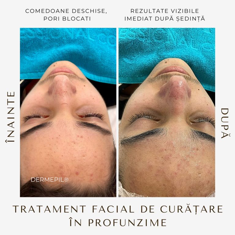tratament-facial-curatare-12.png.jpg