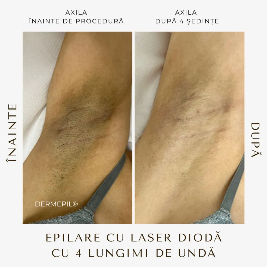 epilare definitiva before and after 1.png
