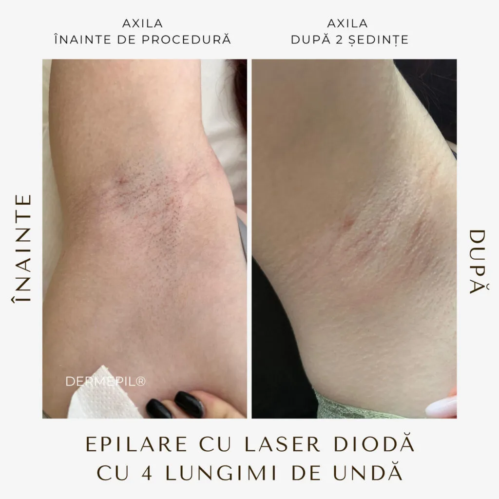 epilare definitiva before and after 2.png
