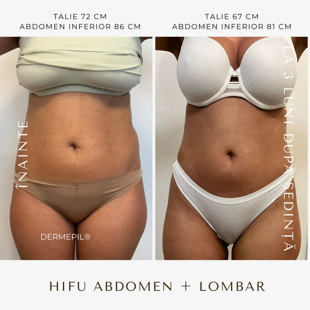 hifu before and after 1.png