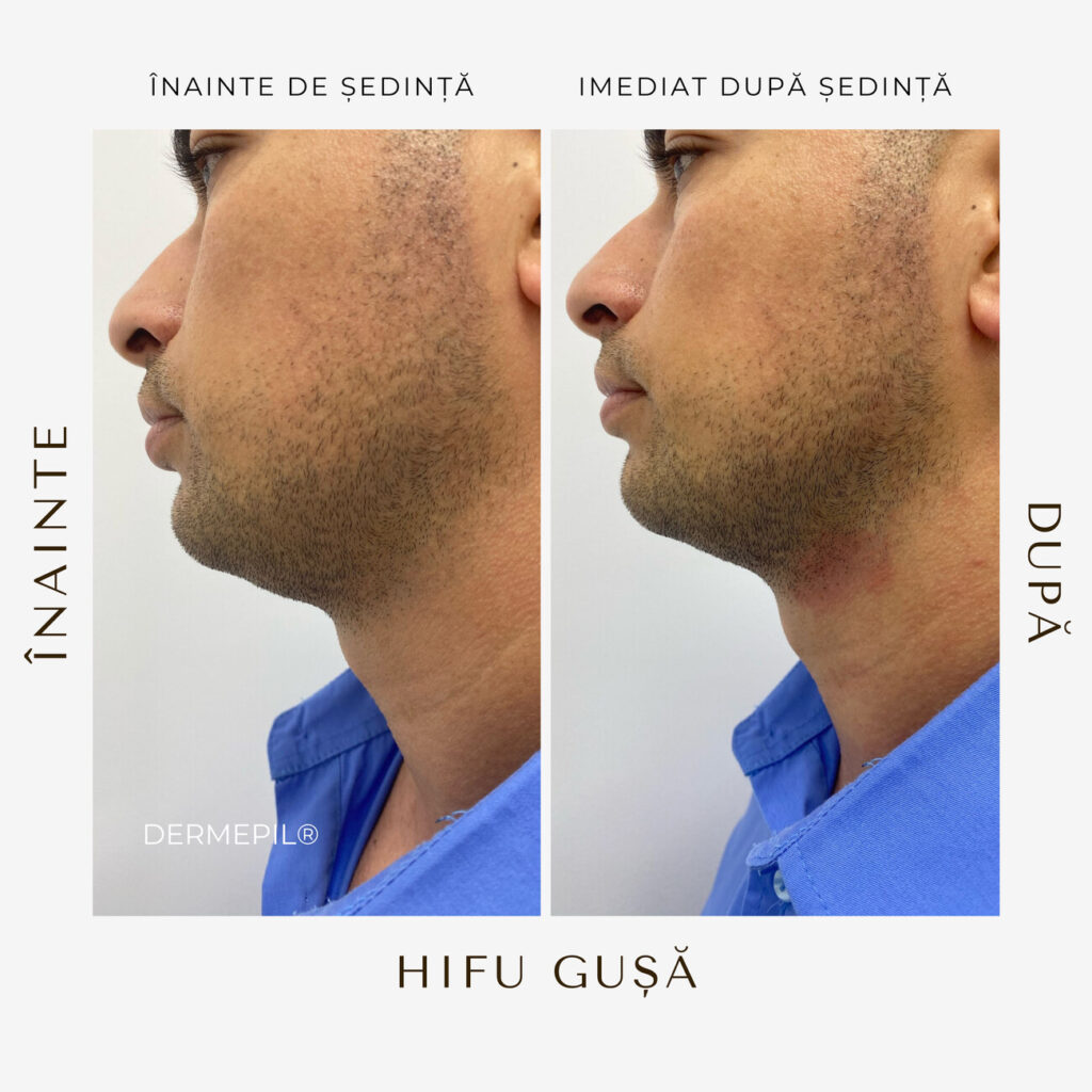 hifu before and after 11.png