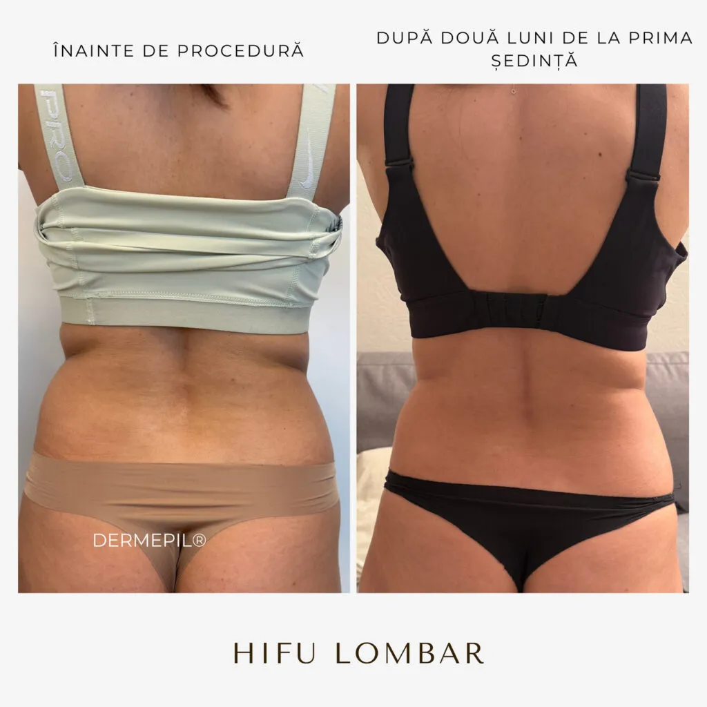 hifu before and after 12.png