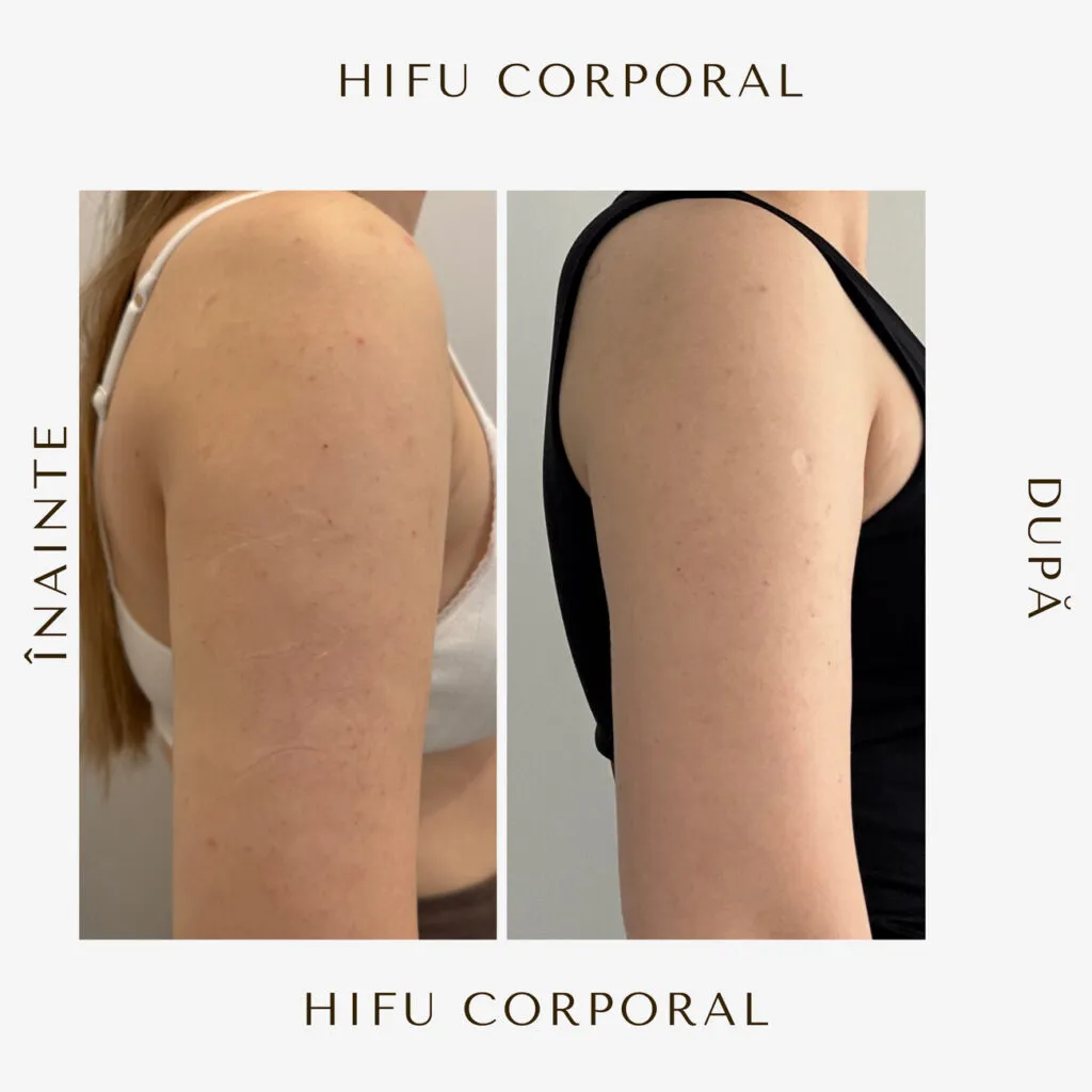 hifu before and after 14