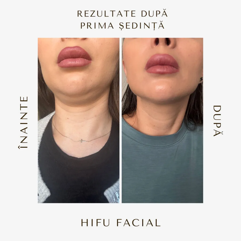 hifu before and after 15