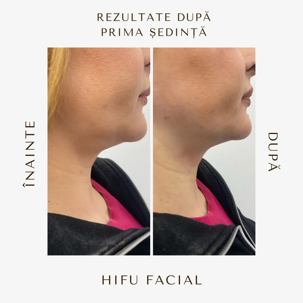 hifu before and after 16