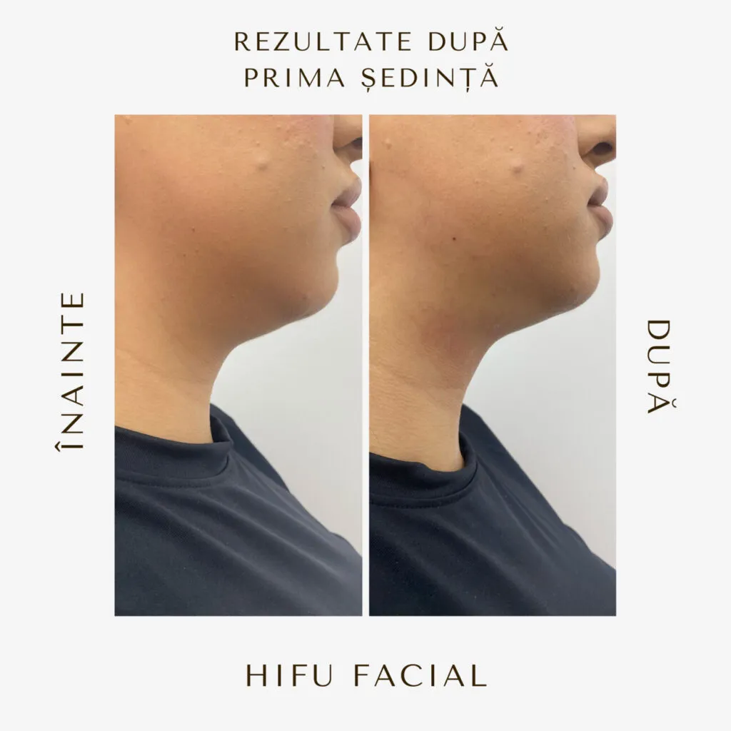 hifu before and after 17