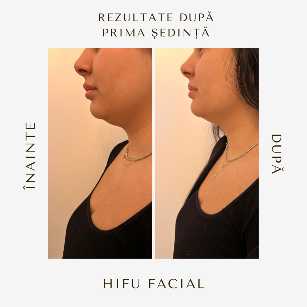 hifu before and after 18