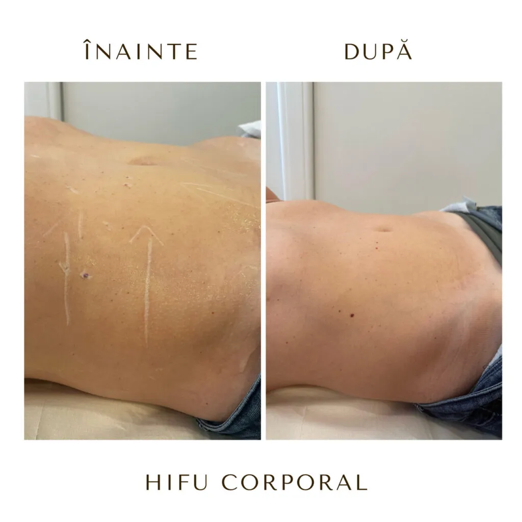 hifu before and after 19