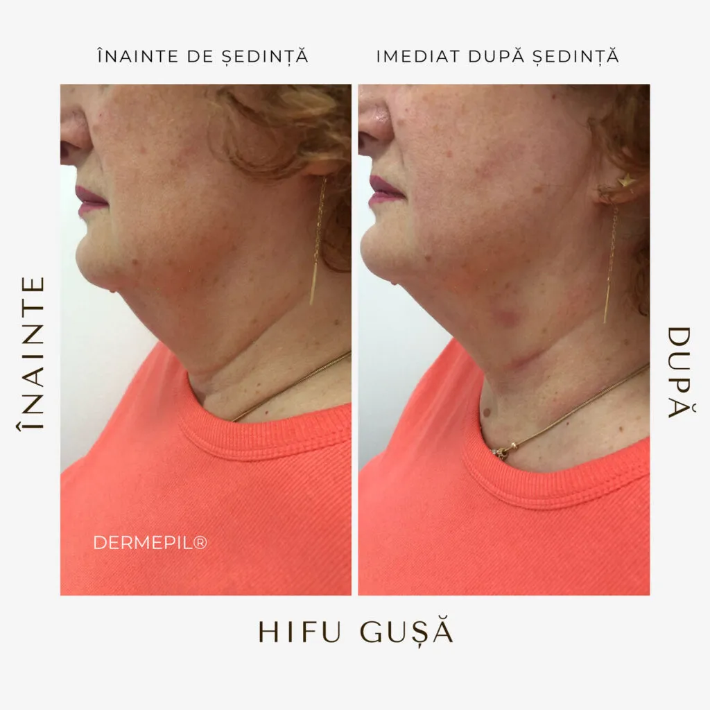 hifu before and after 2.png