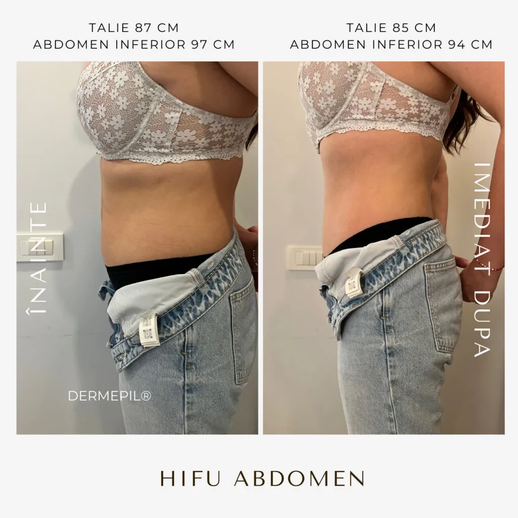 hifu before and after 21.png