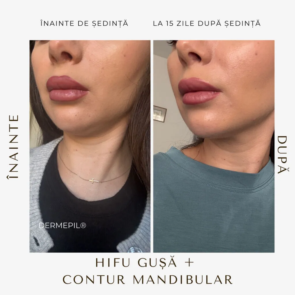 hifu before and after 24.png