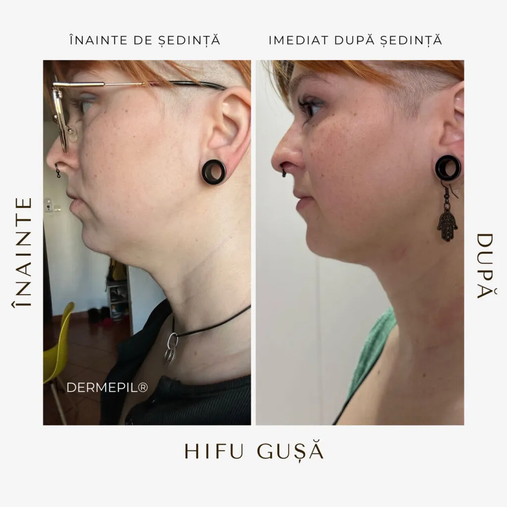 hifu before and after 25.png