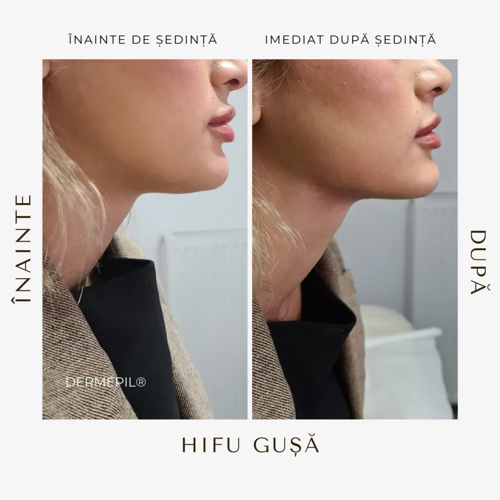 hifu before and after 26.png