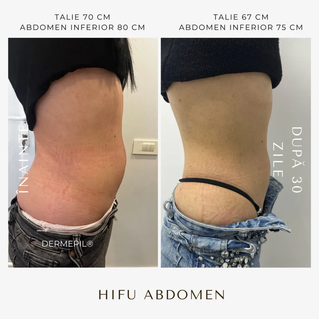 hifu before and after 29.png