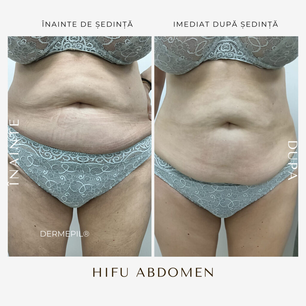 hifu before and after 30.png