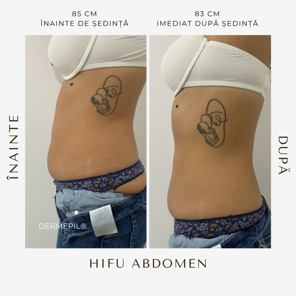 hifu before and after 32.png
