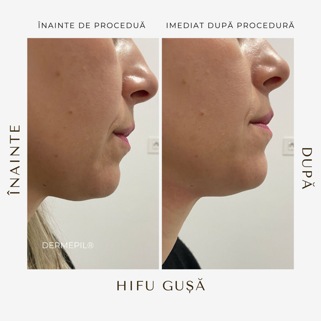 hifu before and after 33.png
