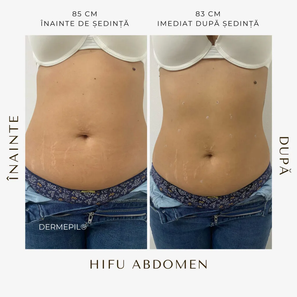 hifu before and after 35.png