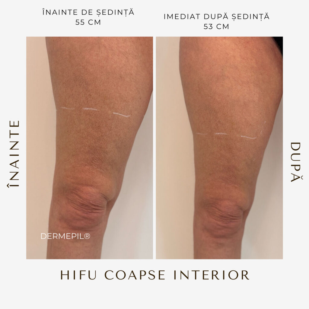 hifu before and after 4.png