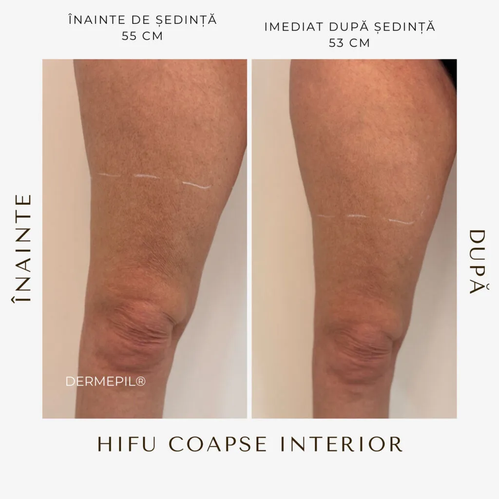 hifu before and after 4.png