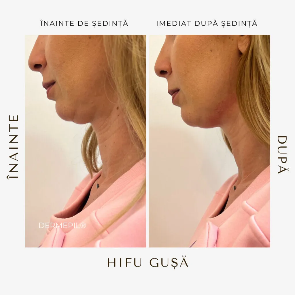 hifu before and after 5.png