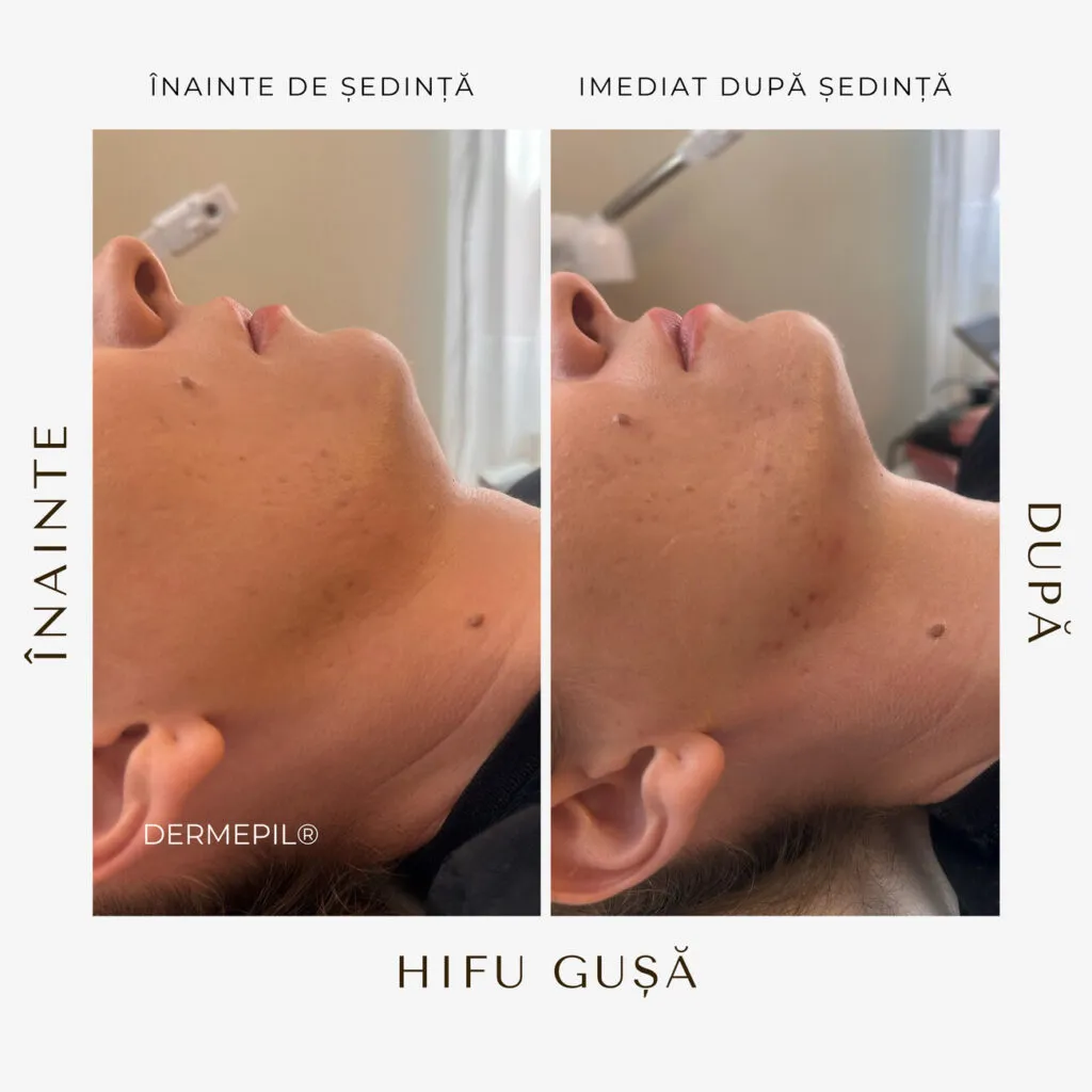 hifu before and after 6.png