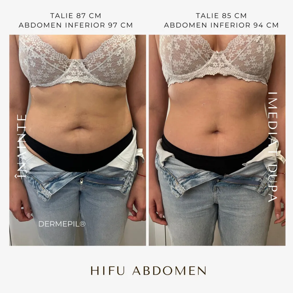 hifu before and after 8.png