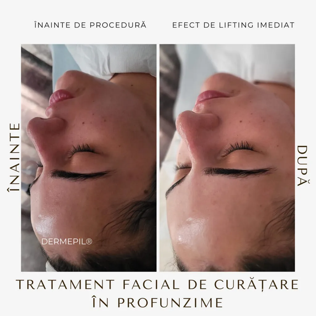 tratament facial curatare 1.png